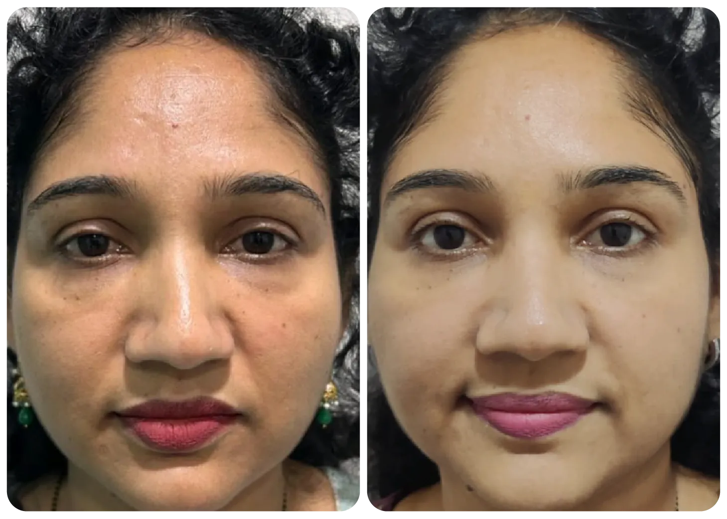 1 RS WHITENING CREAM
